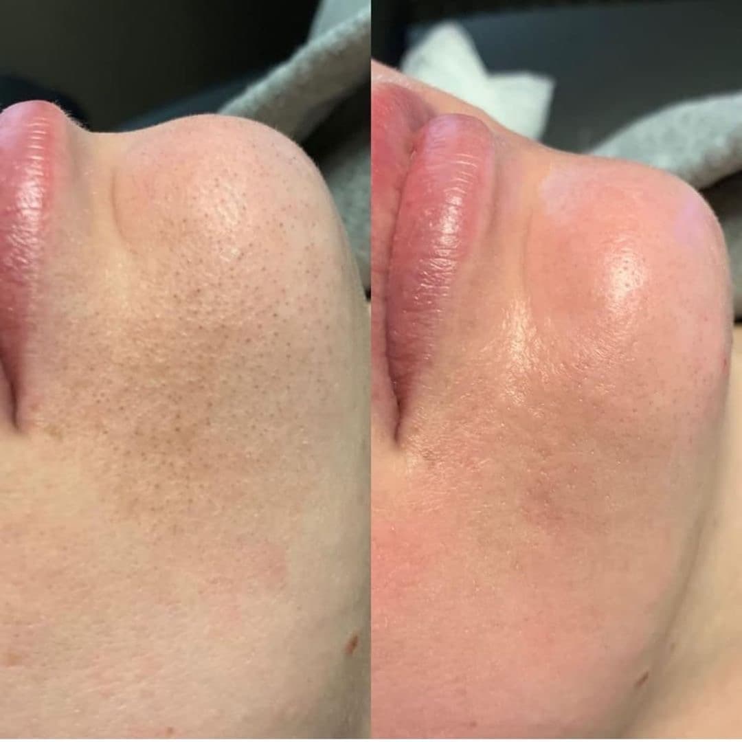 Limpieza Facial Profunda 