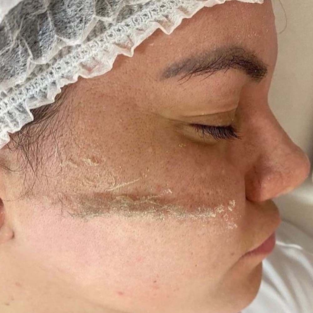 Dermaplaning Facial