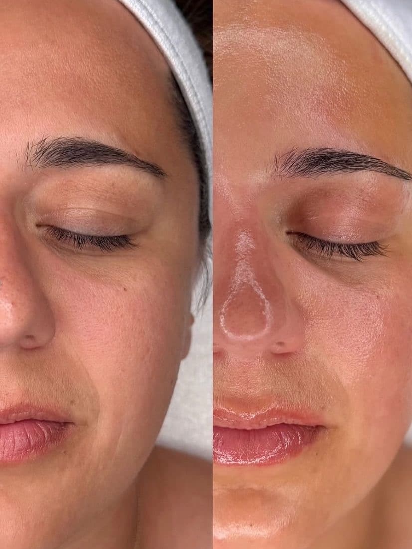 Dermaplaning + Aparatologia