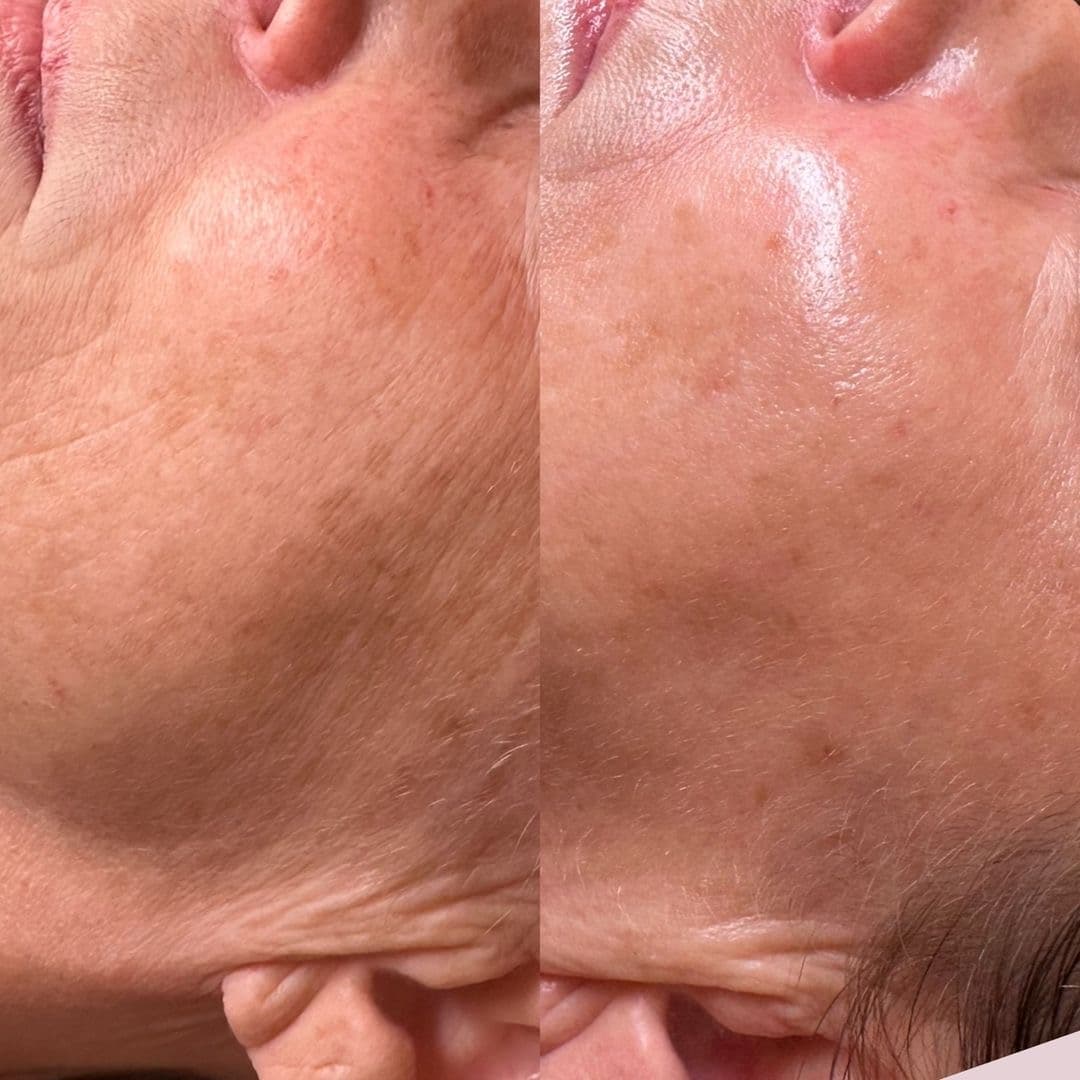 Peeling Químico Facial