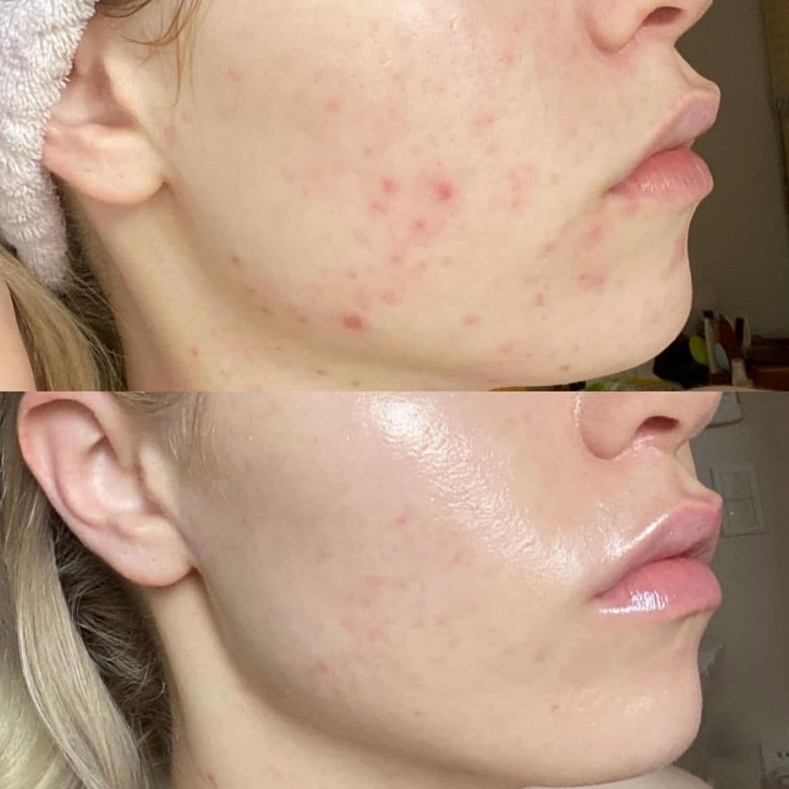 TRATAMIENTO PARA ACNÉ (GRADO I Y II)