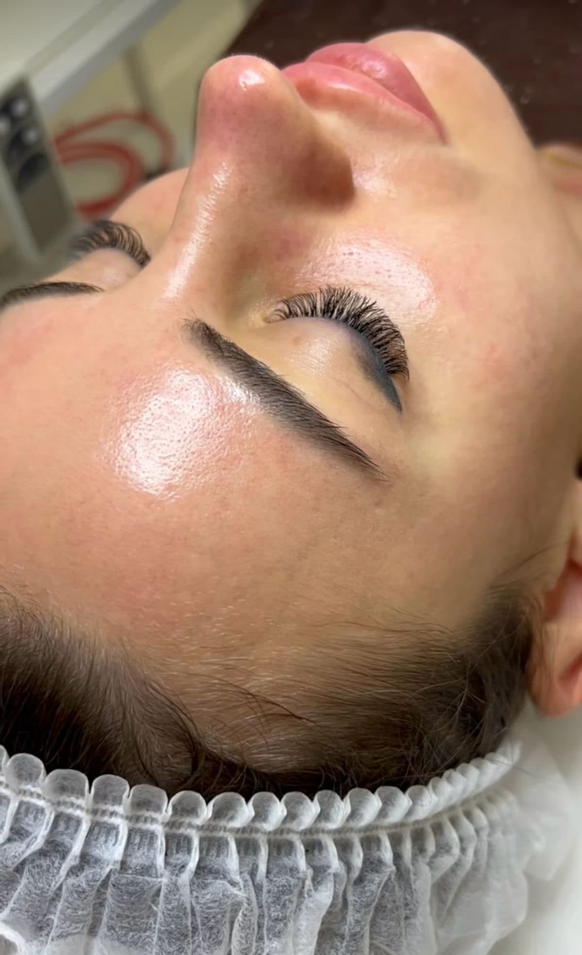 MICRONEEDLING / DERMAPEN