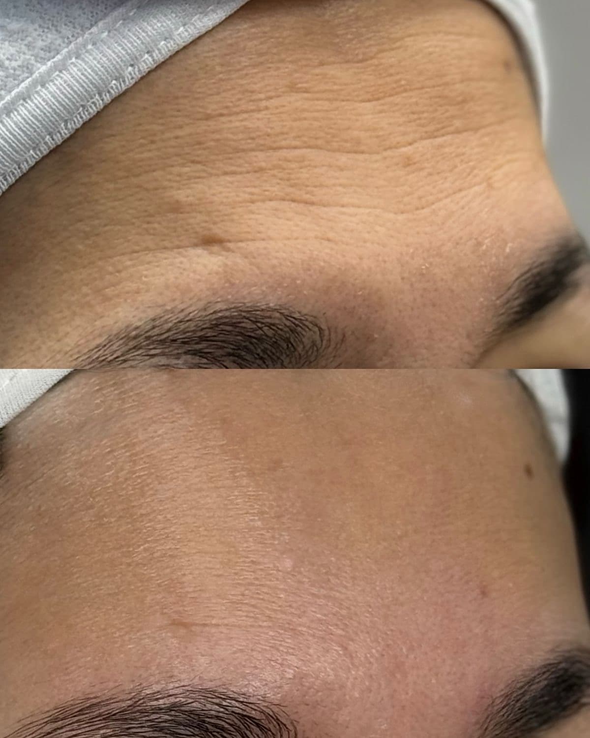 LÍNEAS DE EXPRESIÓN Y ARRUGAS FINAS