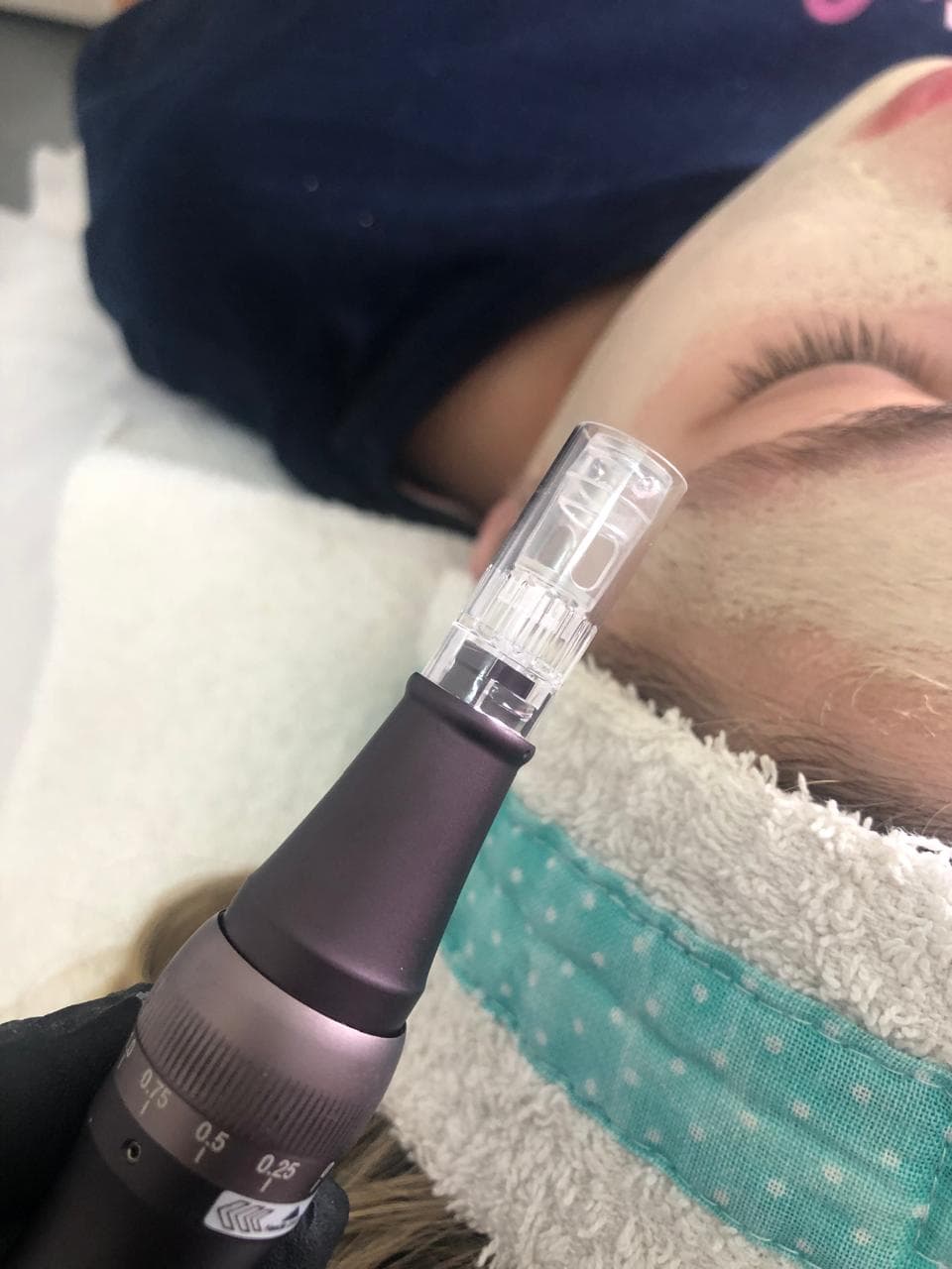 LIMPIEZA FACIAL CON DERMAPEN