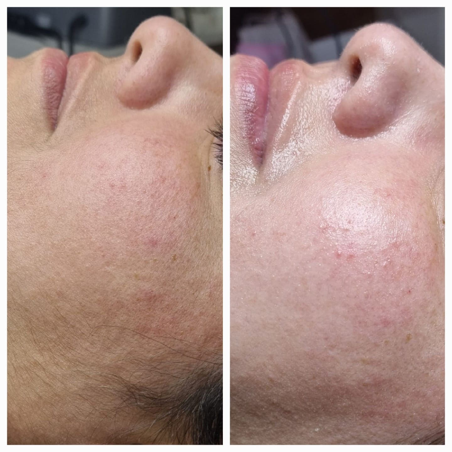 DERMAPLANING