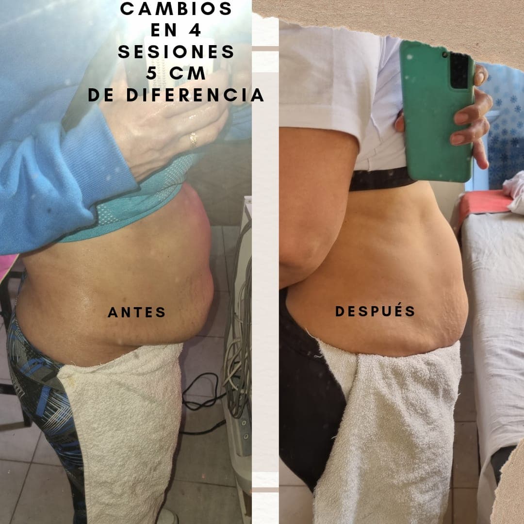 Tratamiento REDUCTOR 4 sesiones