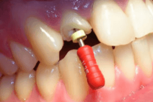 Endodoncia