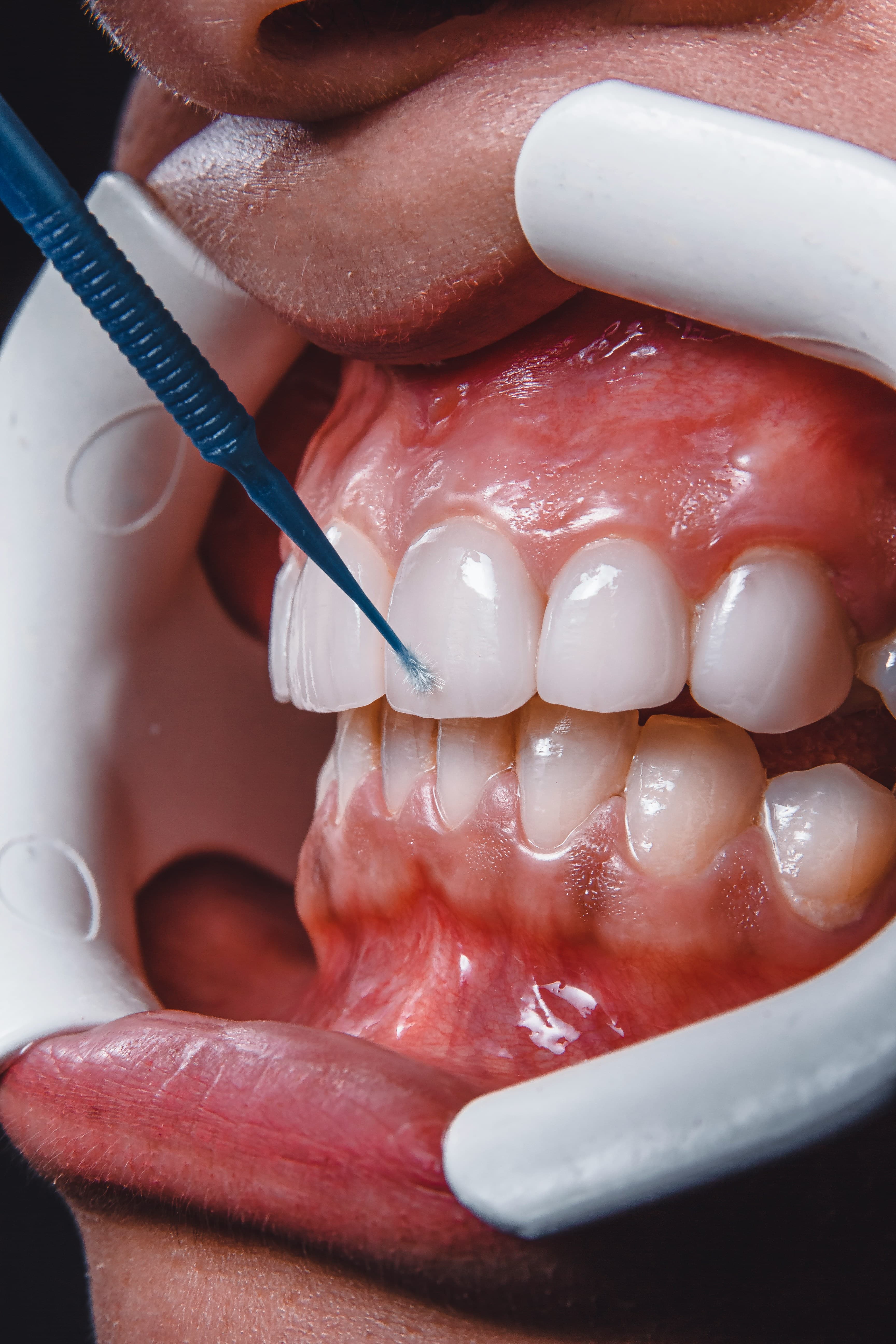 Estética Dental