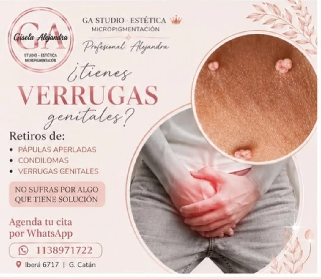 Extracción de Verrugas