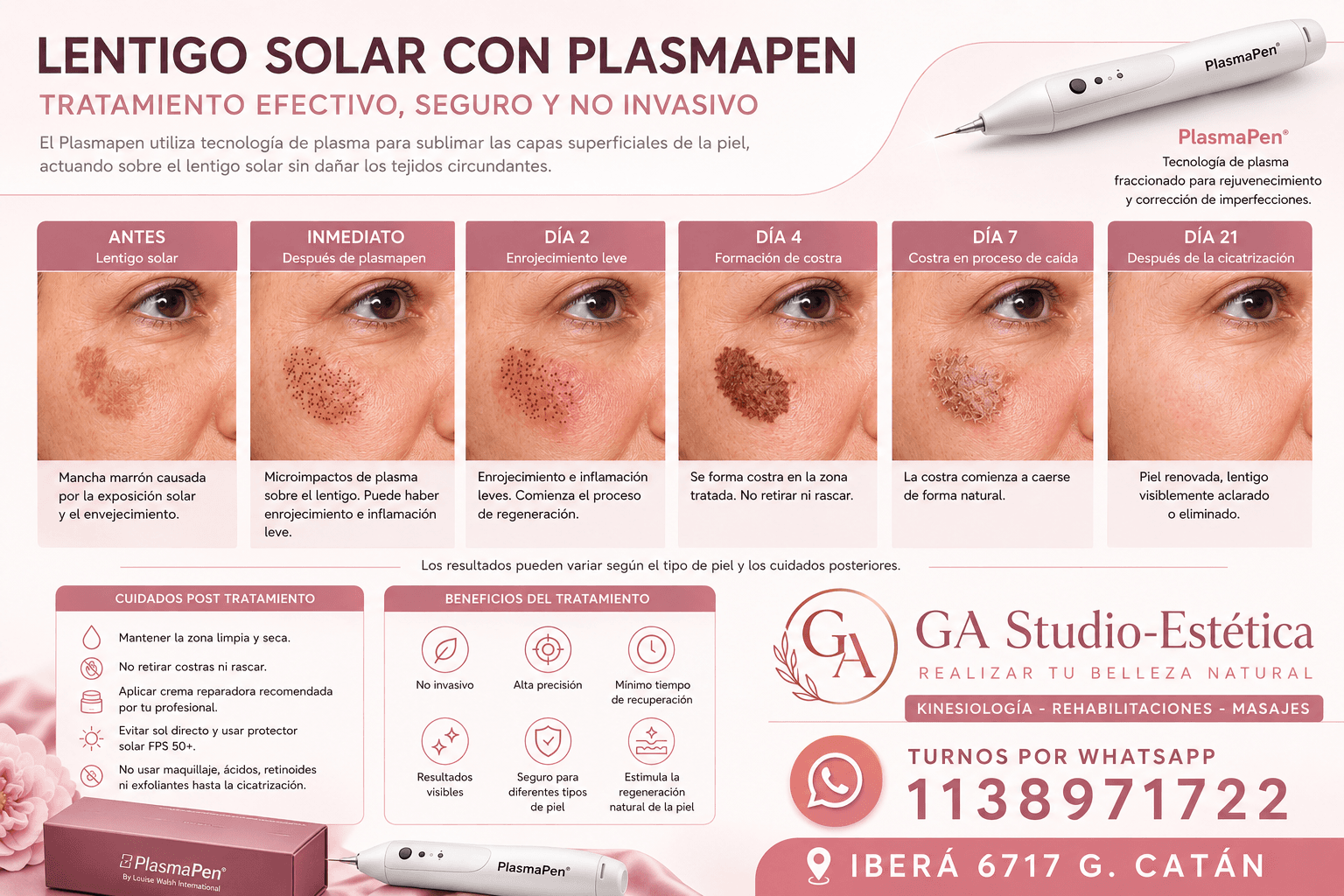 Lentigo Solar con Plasma pen