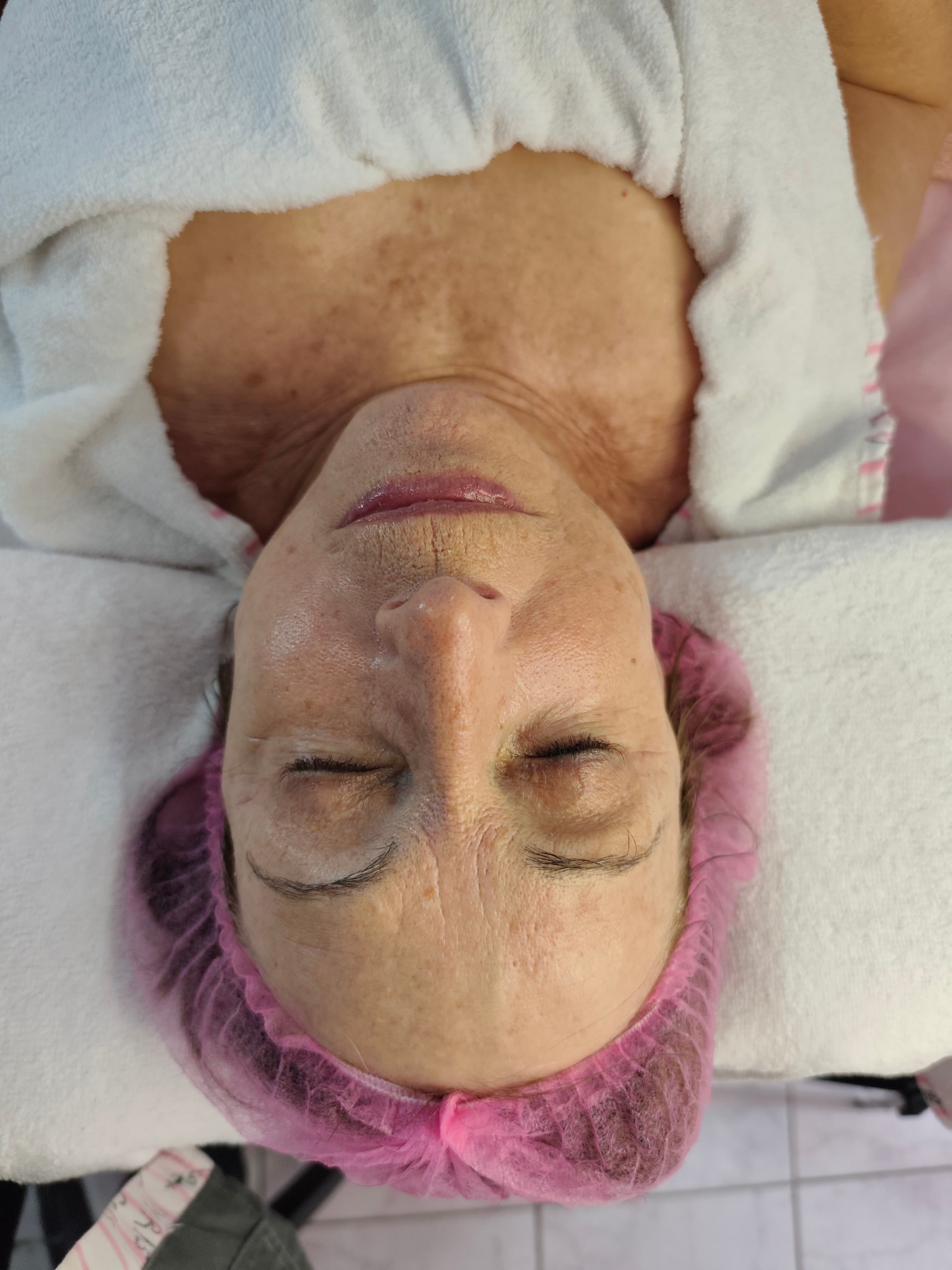 🌛 FACIAL 🌜 Dermapen/Microneedling