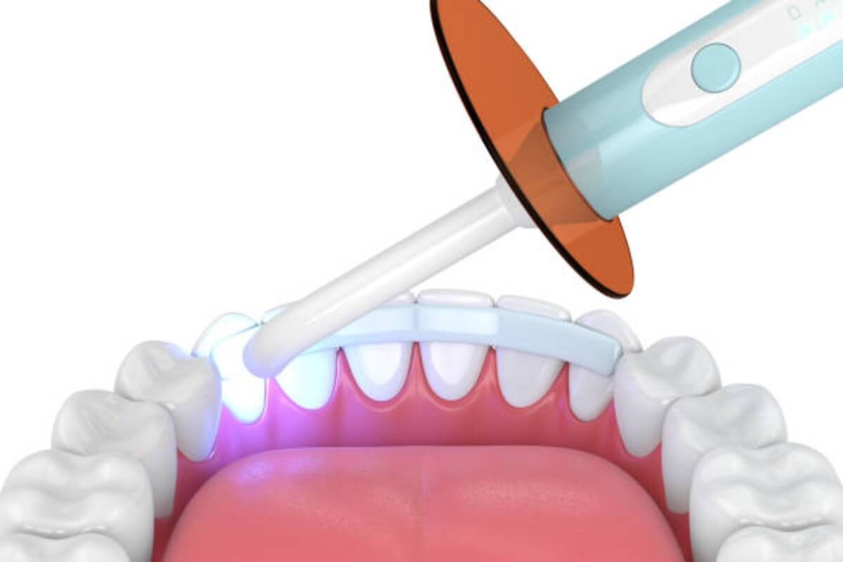 Ferulización dental (1 hora)