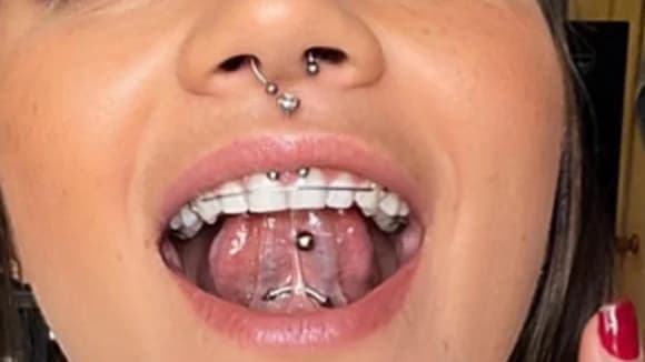 Perforación Medusa/Smiley