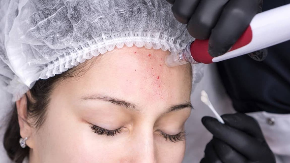 Microneedling (Dermapen)