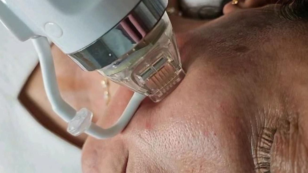 Hifu facial con radiofrecuencia fraccionada