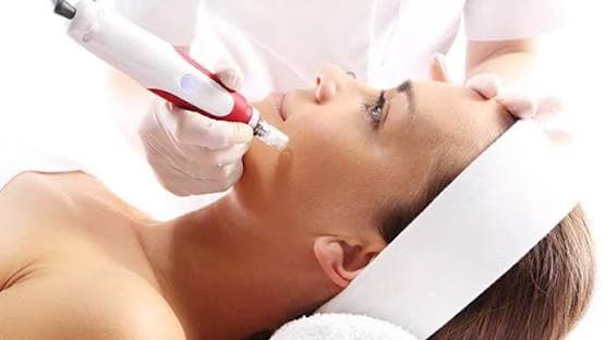 Microneedling con Exosomas o PDRN