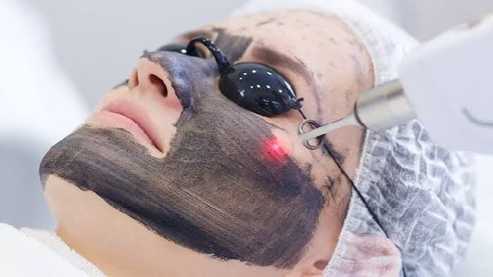 Hollywood peeling