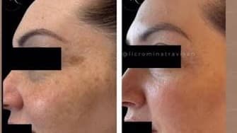 Eliminacion de manchas con laser