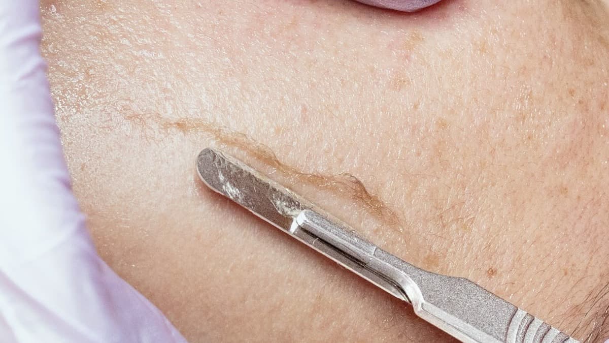 Dermaplaning