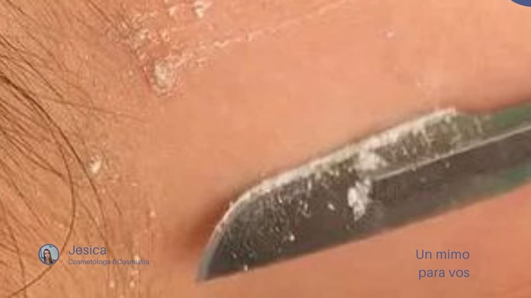 DERMAPLANING