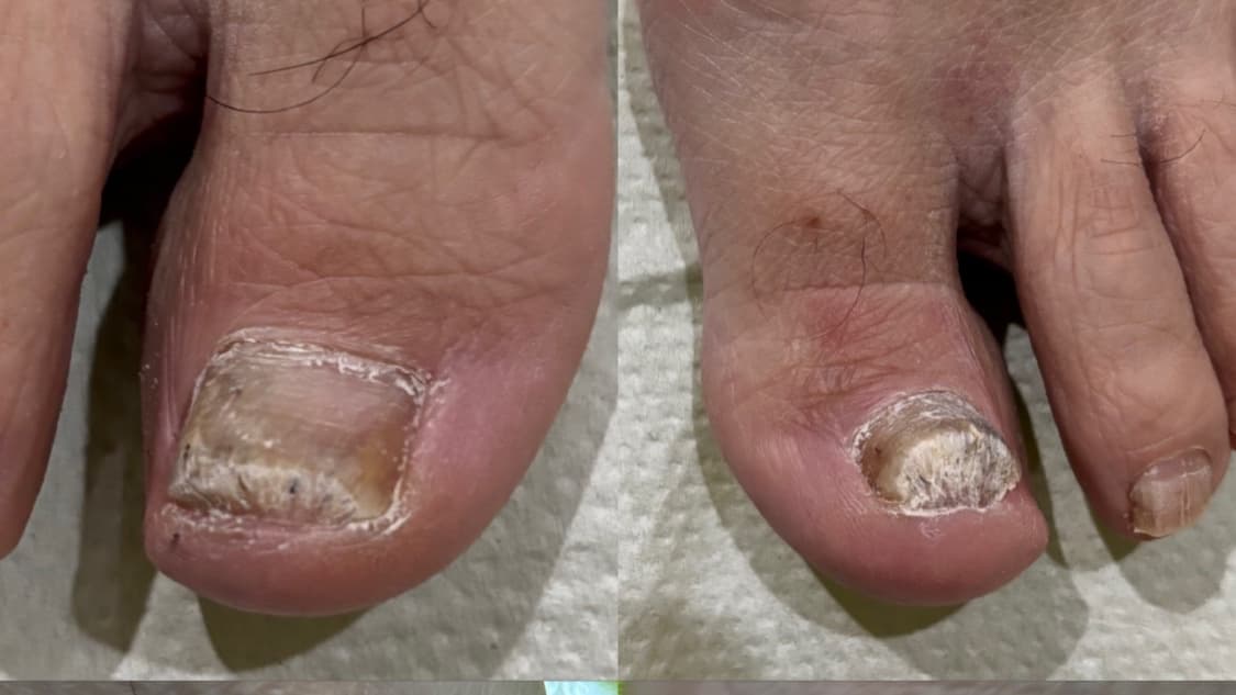Onicomicosis