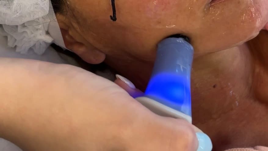 Exilis 360 rostro y cuello