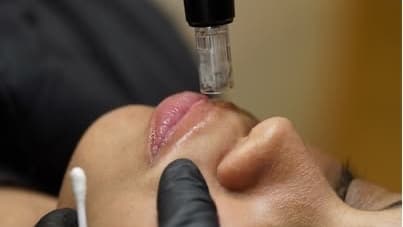 Hidra lips c/ limp prof