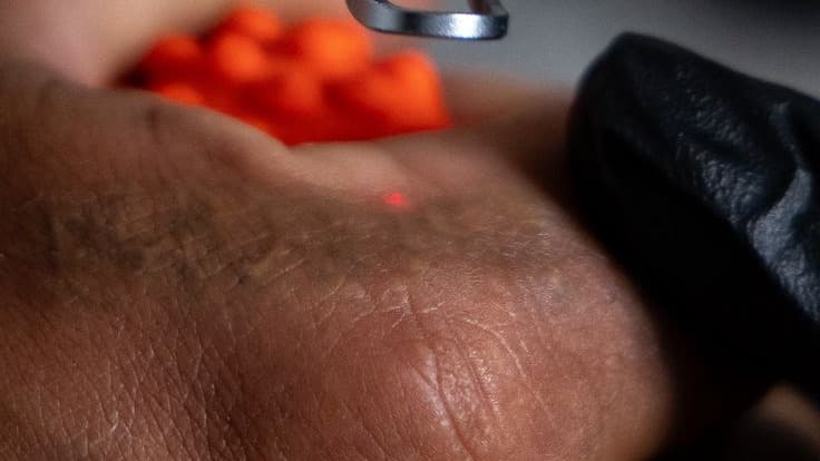 Remoción de tatuajes