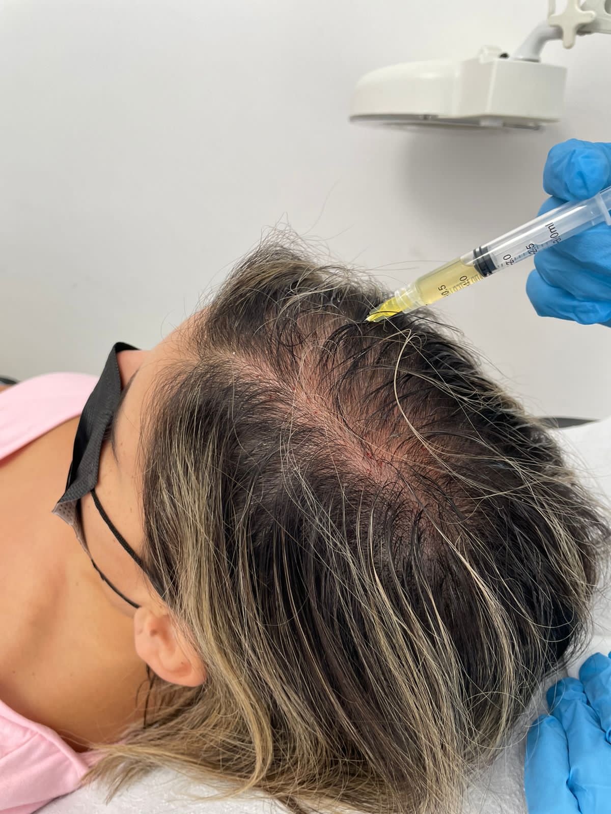 CAPILARES | Mesoterapia capilar