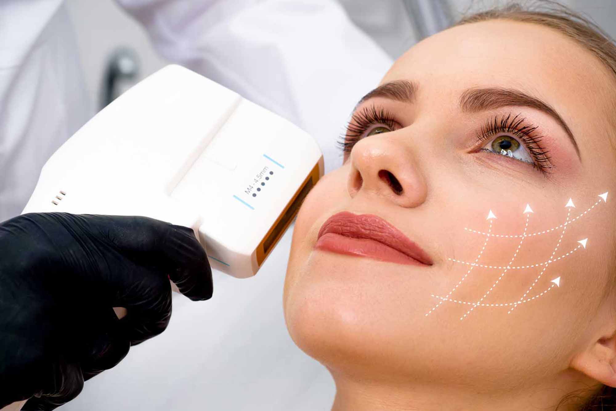 FACIALES | Hifu - ROSTRO, CUELLO Y ESCOTE