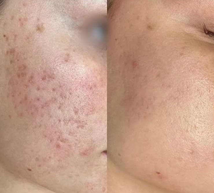 FACIALES | Plan Marcas y cicatrices