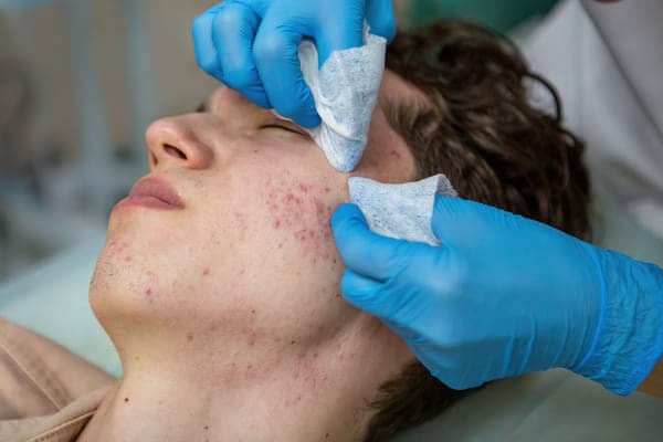 Limpieza facial profunda (con extracciones)